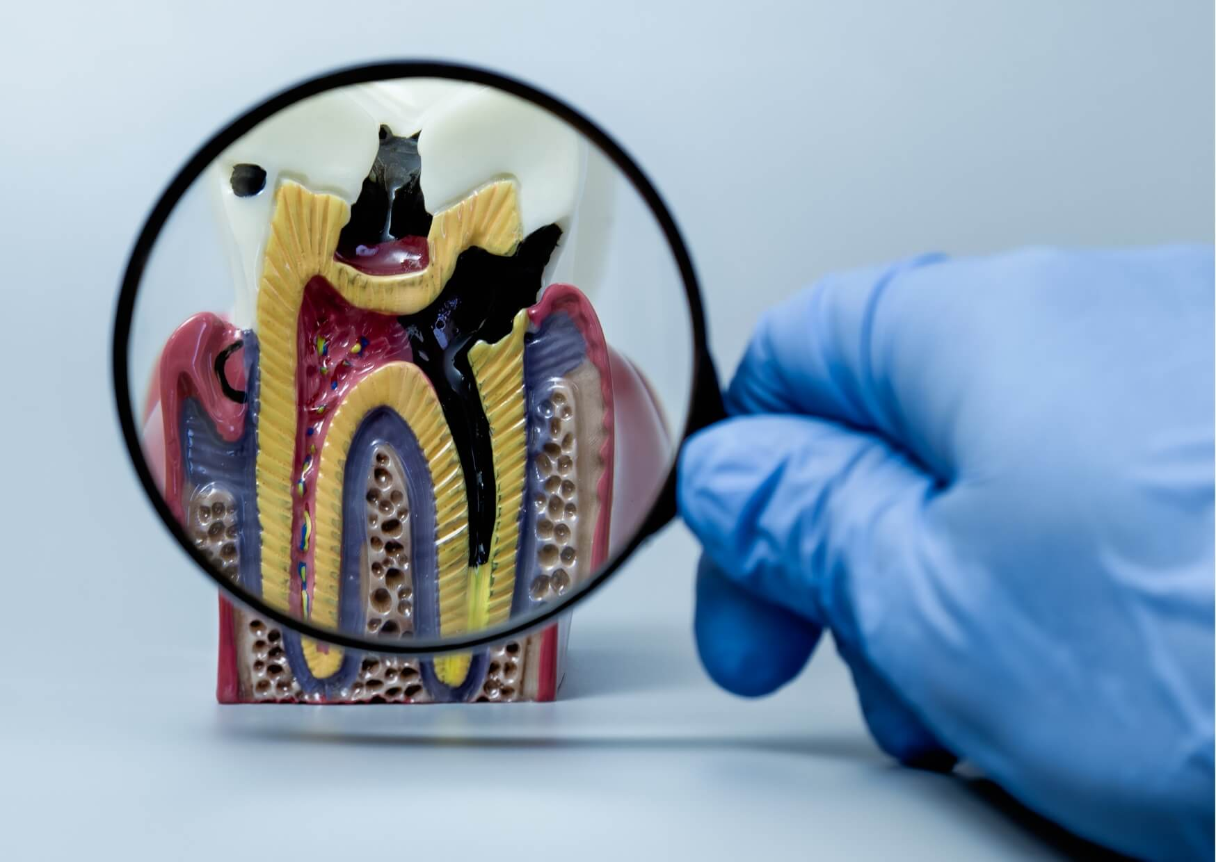 Magnified dental model showing deep tooth decay and cavity damage extending into the inner layers of a tooth.