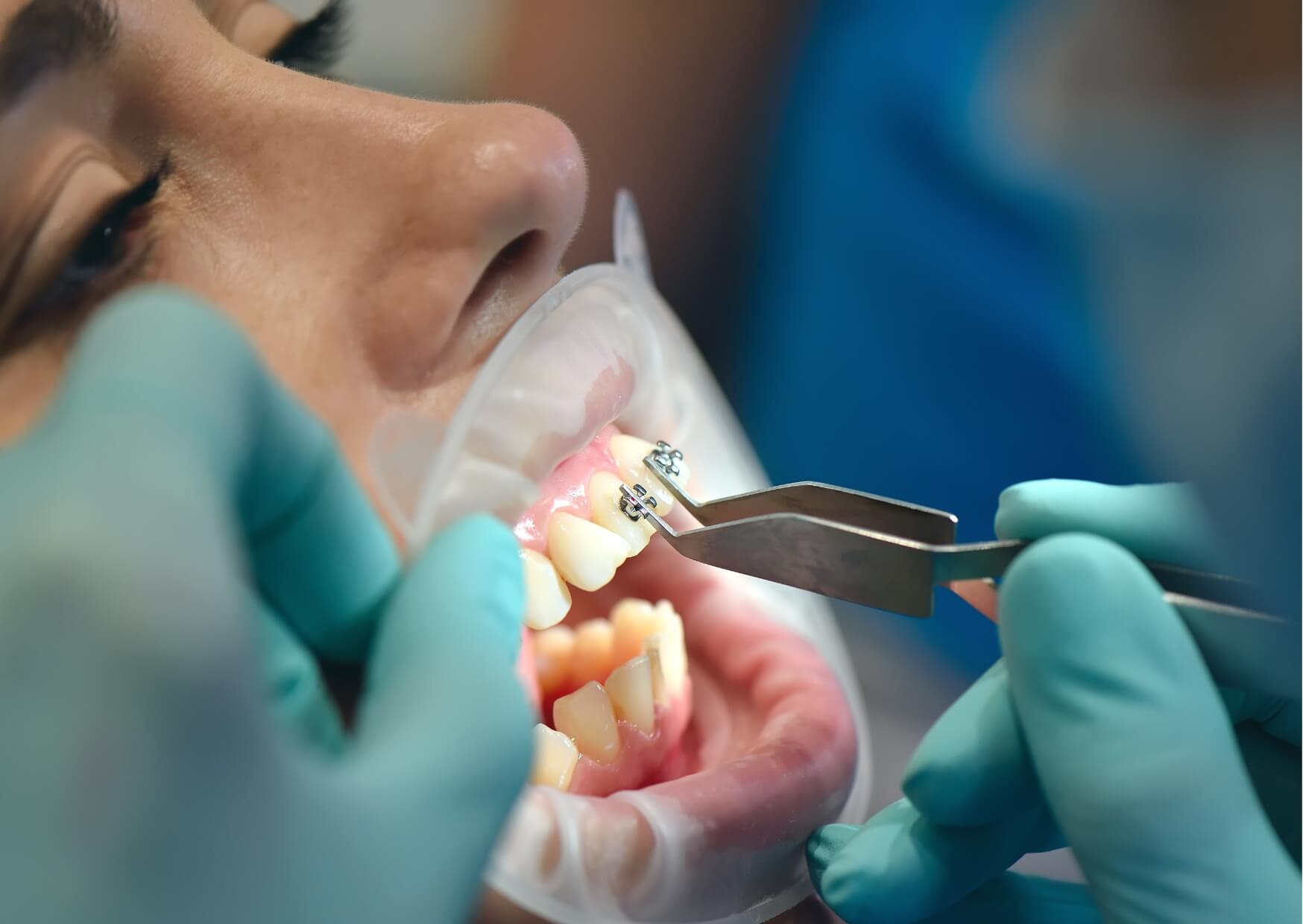 Orthodontist placing braces on a patient's teeth during retreatment for teeth that shifted after braces.