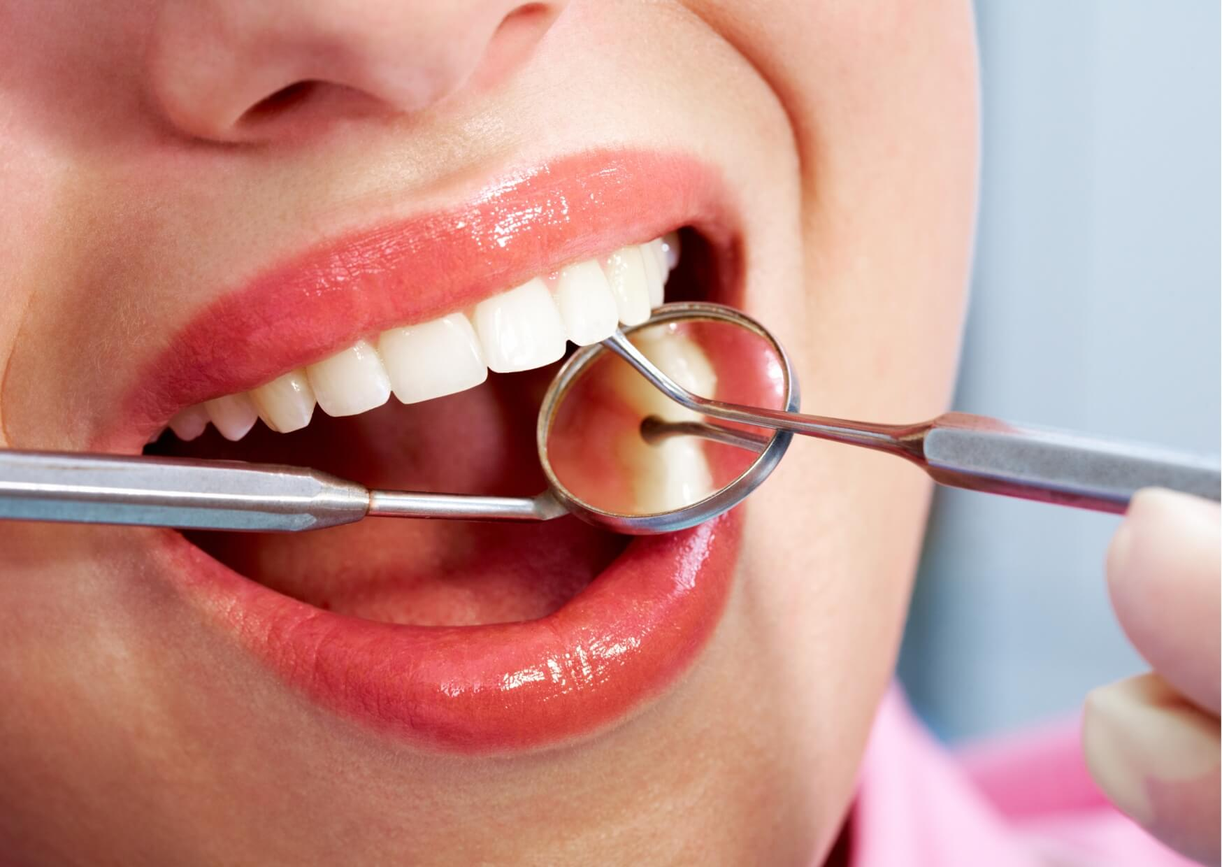 Close-up dental examination of porcelain veneers, illustrating cosmetic treatment often compared by veneer costs by location.