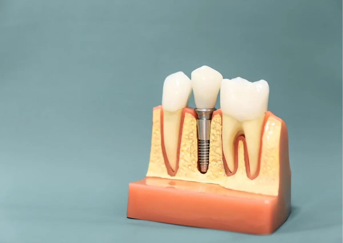 Dental implant model showing how a tooth implant is placed during the treatment process.