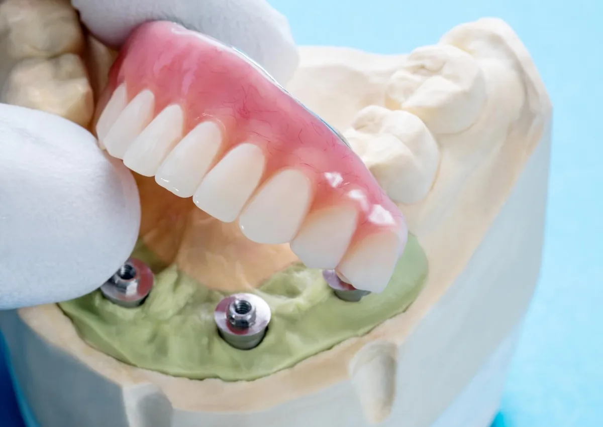 Full mouth dental implant model showing an implant-supported restoration used to replace multiple missing teeth.