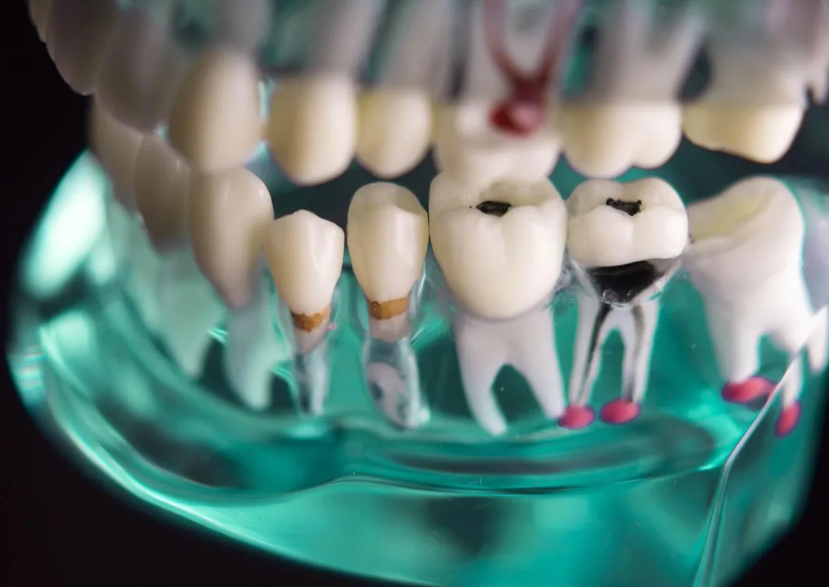 Dental model showing dark cavities and areas of tooth decay on the chewing surfaces of teeth.